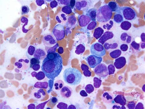 Plasma cell myeloma - Russell bodies