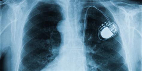 World's Smallest Cardiac Pacemaker Implanted by Farrer Park Hospital ...