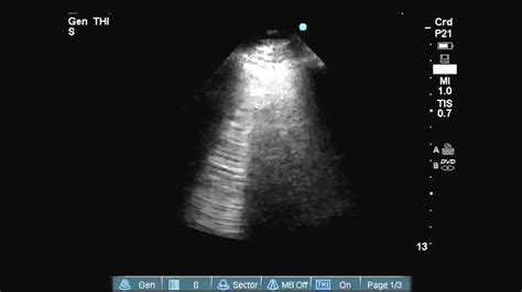 B-lines on lung ultrasound - YouTube