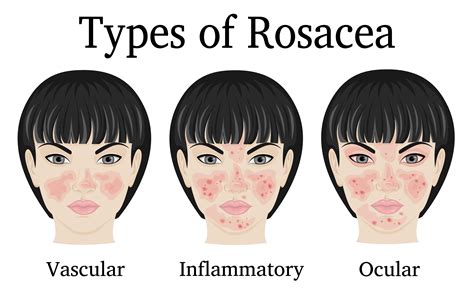 Rosacea Cheeks Treatment