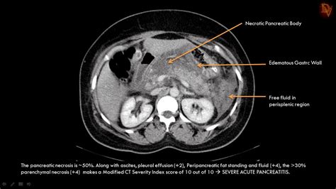 Ultimate Radiology : Acute Necrotizing Pancreatitis