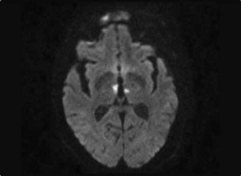 Restricted diffusion in the diffusion weighted sequence of MRI in the ...