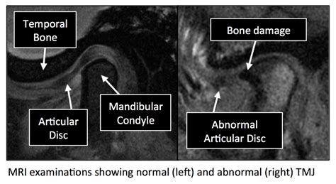 Radiology Anatomy Images : TemporoMandibular Joint MRI anatomy