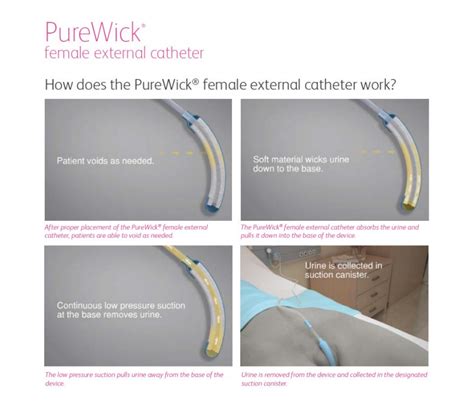 Purewick External Catheter How Often To Change at Rebecca Riley blog