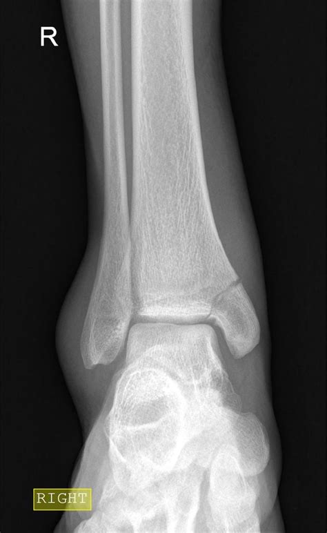 Medial Malleolus