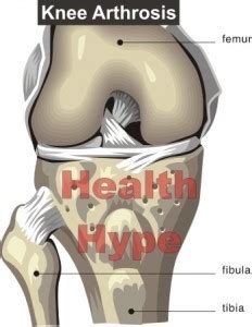 Arthrosis Define, Causes, Symptoms Treatment, Difference | Healthhype.com