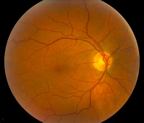 Vitamin A Deficiency and Nyctalopia. EyeRounds.org - Ophthalmology ...