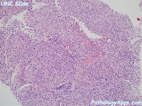 pilocytic astrocytoma pathology