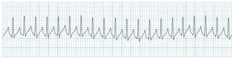 Paroxysmal Atrial Tachycardia Vs Sinus Tachycardia