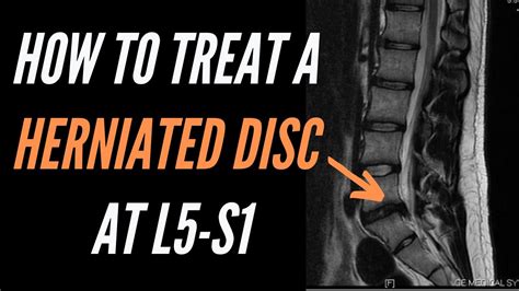 How To Treat A Herniated Disc At L5 S1 - YouTube