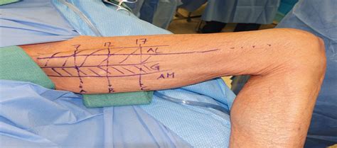 The Profunda Artery Perforator Flap: A Versatile Option for ...