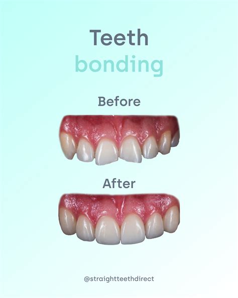 Is teeth bonding a good idea? What to do after aligner treatment