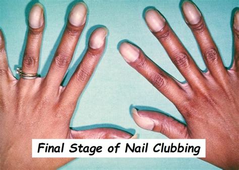 Nail Clubbing: Signs, Stages and Treatment – NailDesignCode