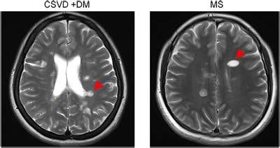 Frontiers | Dawson's Fingers in Cerebral Small Vessel Disease