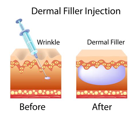 Dermal Fillers Uses Types Risks And Procedure