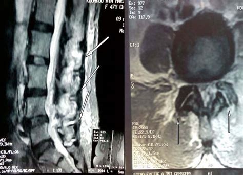 Tuberculosis of Zygapophyseal Joint: A Report of 3 Cases Observed in ...