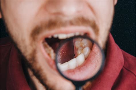 HIV Mouth Symptoms That You should Know | oregoncareersinhealthcare