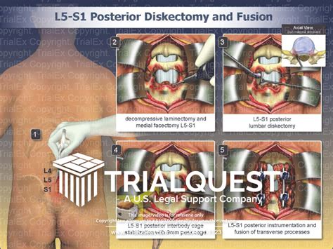 L5-S1 Posterior Diskectomy and Fusion - TrialQuest Inc.