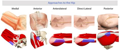 Relieve Pain with These Hip Replacement Approaches