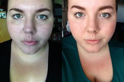 Azelaic Acid Rosacea Before And After