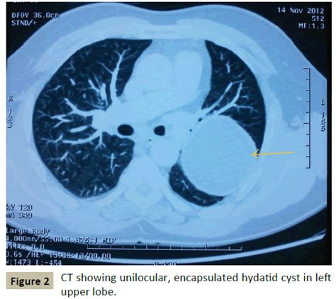 Uncommon Hydatid Cyst in Lung