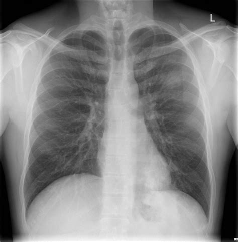 [DIAGRAM] Diagram Pneumonia X Ray - MYDIAGRAM.ONLINE