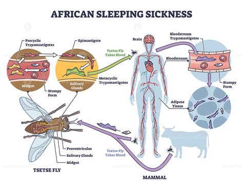 African sleeping sickness or African trypanosomiasis illustration ...