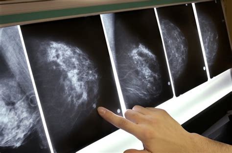 Mammography and overdiagnosis, revisited | Science-Based Medicine