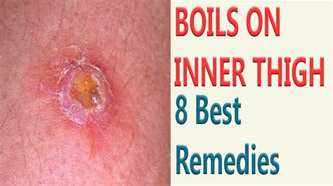 8 Best Remedies To Get Rid Of Boils On Inner Thigh - YouTube