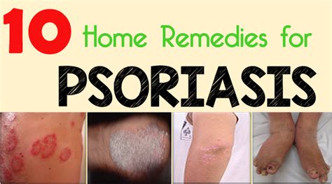 10 Home Remedies for Psoriasis - Getinfopedia.com