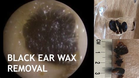 BLACK EAR WAX REMOVAL - #437 - YouTube