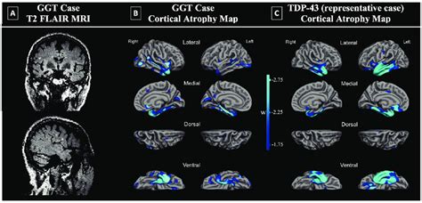 Imaging findings in GGT case and comparison to TDP. A. Patient's T2 ...