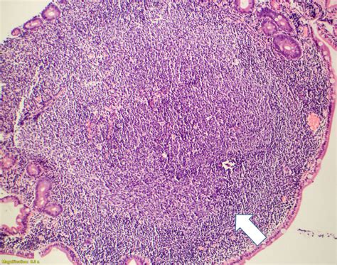 Pathology Outlines - Follicular lymphoma-duodenal type