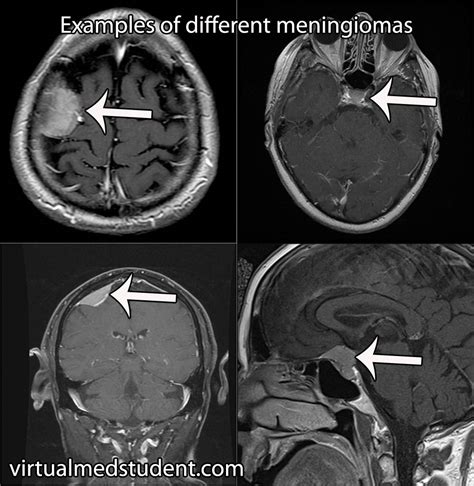 meningioma - VirtualMedStudent.com