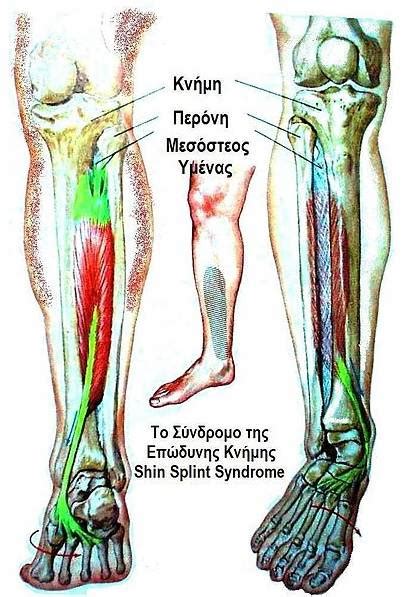 Shin-splints - Physiopedia