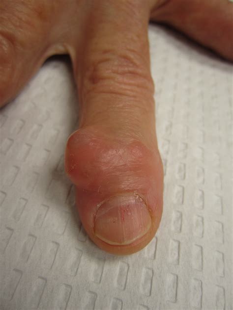 Photos of Mucous Cysts in Fingers - John Erickson, MD