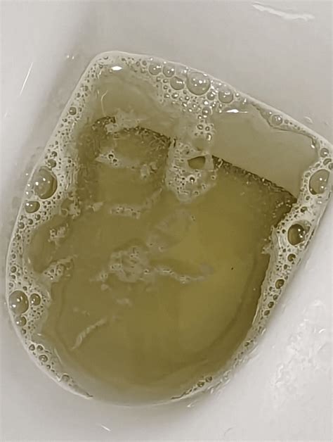 Any ideas ? I've had bubbly urine for a while looks like there's werid ...