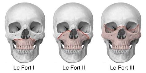 Le Fort Fracture | Definition, Fracture Types, And Symptoms