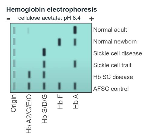 Hemoglobin electrophoresis - Wikiwand