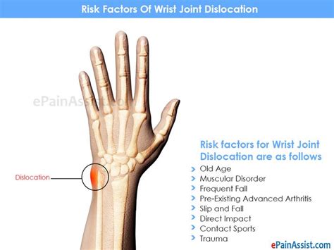 Rheumatoid Arthritis ** Click image for more details. # ...