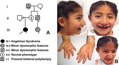 What Is Angelman Syndrome? - StoryMD