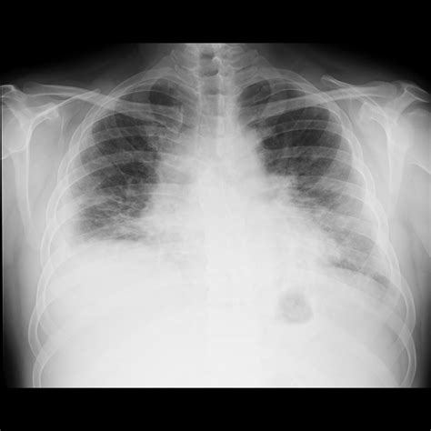 Pulmonary Edema Chest X Ray