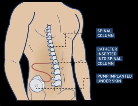 Intrathecal Baclofen Withdrawal – Core EM