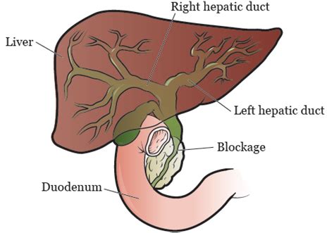 About Your Biliary Drainage Catheter | Memorial Sloan Kettering Cancer ...