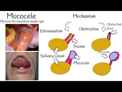 Oral Mucocele - The Most Common Mucosal lesion - Mucous Cyst: Symptoms ...