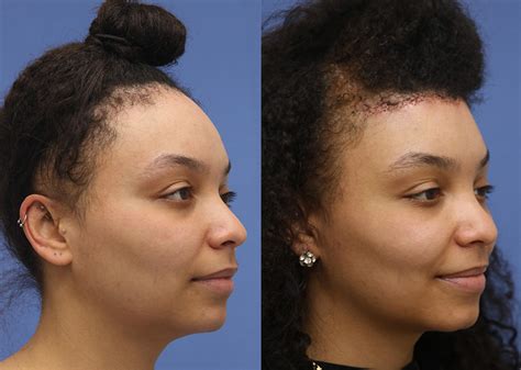 Forehead Reduction Before and After 01