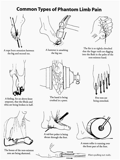 Phantom limb pain | Steinmann Prosthetics & Orthotics