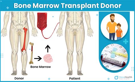 What is Bone Marrow Transplant? Procedure, Success Rate