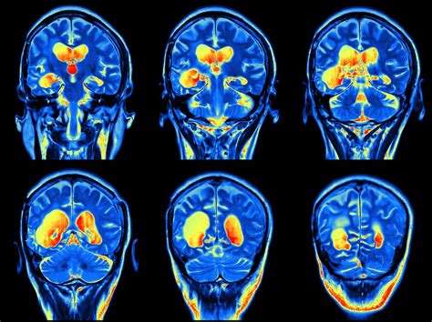 Ms Brain Mri With Contrast