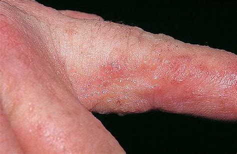 Pompholyx (Dyshidrosis) – Pictures, Symptoms, Causes and Treatment